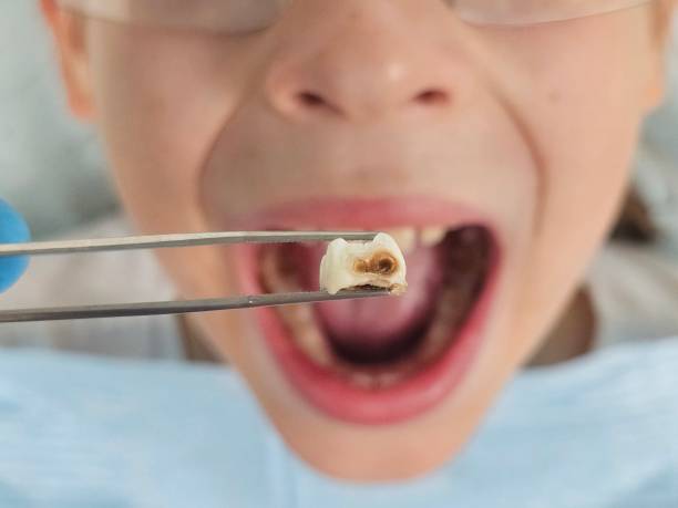 Best Knocked-Out Tooth (Avulsed Tooth) Treatment in East Liverpool, OH